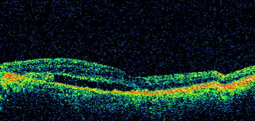 Juxtapapillary CNVM and Serous Macular Detachment Wet AMD Rx Laser
85-year-old man OD is 20/25, OS is 20/100.  IOP:  OD 21, OS 22.  

OS:   Vertical C/D ratio is 0.1.  There is a posterior vitreous separation.  There is a hemorrhagic pigment epithelial detachment on the superior pole of the optic nerve, extending a disc-and-a-half diameter off the nerve, with adjacent exudates.  There is a serous macular detachment involving the center of the fovea.  

VA improved from 20/100 to 20/50 in four months from laser.
Keywords: wet; juxtapapillary;laser;amd;serous;detachment