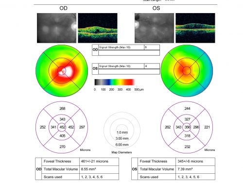 Macular Pucker Pre-OP 20/200 
