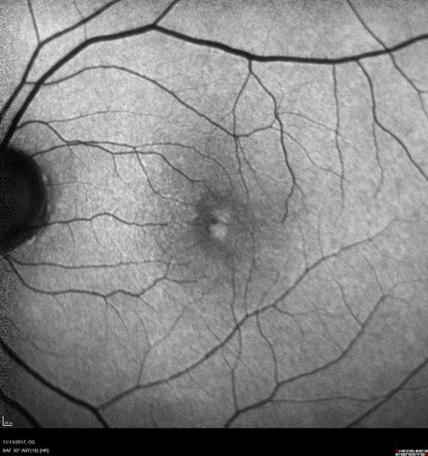 Prefoveal Opercula and early Lamellar Macular Hole
73 year old man with 20/32 vision and pre-foveal opercula.  The OCT shows very early lamellar hole with lamellar hole epiretinal proliferation
