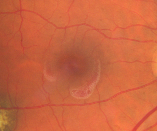 Pre-retinal hemorrhage following Posterior Vitreous Detachment (separation - PVD)
68 year old woman with acute PVD OD and new preretinal hemorrhage - also there is a macular nevus
