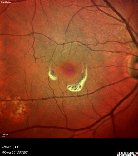 Pre-retinal hemorrhage following Posterior Vitreous Detachment (separation - PVD)
68 year old woman with acute PVD OD and new preretinal hemorrhage - also there is a macular nevus
