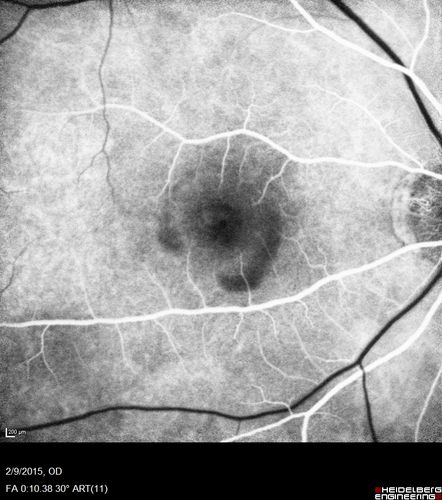 Pre-retinal hemorrhage following Posterior Vitreous Detachment (separation - PVD)
68 year old woman with acute PVD OD and new preretinal hemorrhage - also there is a macular nevus
