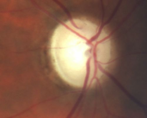 Old Subhyaloid - Preretinal Hemorrhage (Yellow)  - Traumatic Optic Neuropathy
53-year-old man 3 monts previous was hit in a motor vehicle/pedestrian accident and was mostly bedridden and in and out of consciousness for two months.  It is now three months since the injury.   His right eye has permanent vision loss from optic nerve injury.  His left eye has reasonable vision, but he does notice a floater often obstructing his vision in that eye. OD is 1/200, OS is 20/20. 
