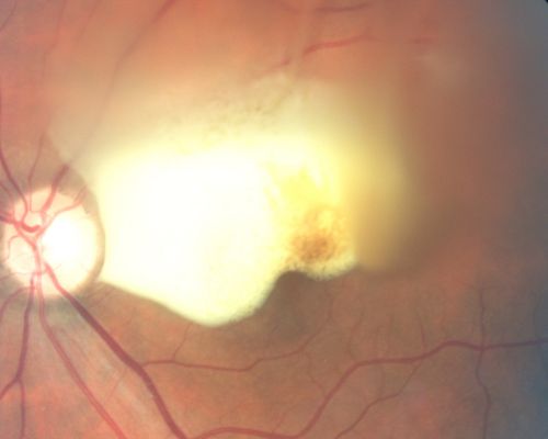 Old Subhyaloid - Preretinal Hemorrhage (Yellow) 
53-year-old man 3 monts previous was hit in a motor vehicle/pedestrian accident and was mostly bedridden and in and out of consciousness for two months.  It is now three months since the injury.   His right eye has permanent vision loss from optic nerve injury.  His left eye has reasonable vision, but he does notice a floater often obstructing his vision in that eye. OD is 1/200, OS is 20/20. 
