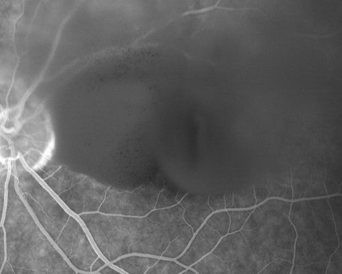 Old Subhyaloid - Preretinal Hemorrhage (Yellow) 
53-year-old man 3 monts previous was hit in a motor vehicle/pedestrian accident and was mostly bedridden and in and out of consciousness for two months.  It is now three months since the injury.   His right eye has permanent vision loss from optic nerve injury.  His left eye has reasonable vision, but he does notice a floater often obstructing his vision in that eye. OD is 1/200, OS is 20/20. 
