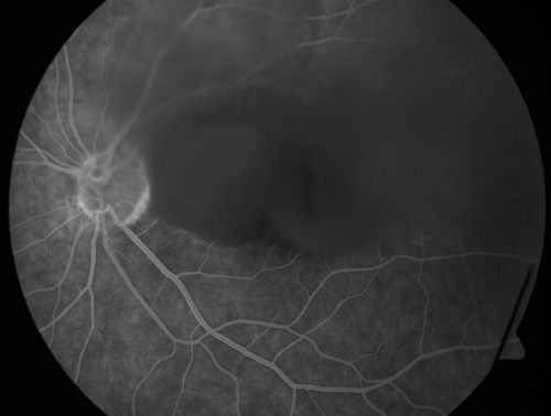 Old Subhyaloid - Preretinal Hemorrhage (Yellow) 
53-year-old man 3 monts previous was hit in a motor vehicle/pedestrian accident and was mostly bedridden and in and out of consciousness for two months.  It is now three months since the injury.   His right eye has permanent vision loss from optic nerve injury.  His left eye has reasonable vision, but he does notice a floater often obstructing his vision in that eye. OD is 1/200, OS is 20/20. 
