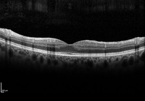 Normal right eye - 4 years later gets CRAO
