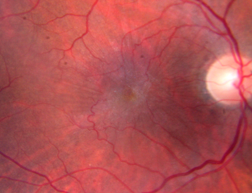 Macular Pucker Pre-OP 20/200 
