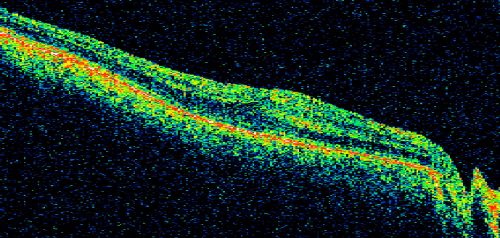 Macular Pucker - 1 year after Vitrectomy - 20/25 Vision - Postoperative Images
60-year-old man had vitrectomy for a macular pucker in the right eye a year ago.  His vision is good.

VISUAL ACUITY:  Vision OD is 20/25 Eye is now pseudophakic
