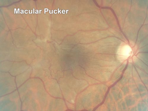 Macular Pucker - 3 Weeks Vision Loss - 20/50 Vision - Preoperative Images
PREOP:
59-year-old man new onset floaters about a year ago.  Subsequent to that his vision was not quite right in the right eye and then he noticed, starting about three weeks ago, substantial change in the vision.   VISUAL ACUITY:  Vision OD is 20/50, OS is 20/16
