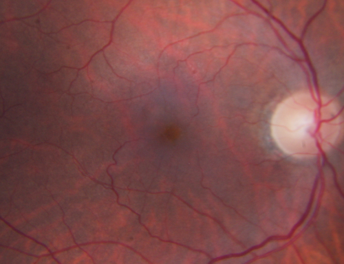Macular Pucker Post-OP 20/30
