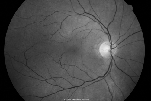 Macular Pucker Post-OP 20/30
