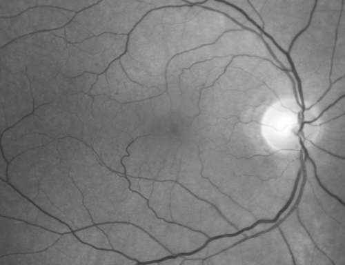 Macular Pucker Post-OP 20/30

