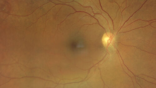 Macular pucker in the left eye
Vision was 20/125 pre-op and 20/25 post-op.
