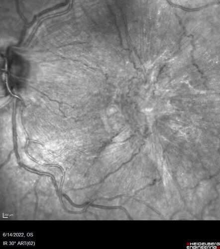 Macular pucker in the left eye
Vision was 20/125 pre-op and 20/25 post-op.
