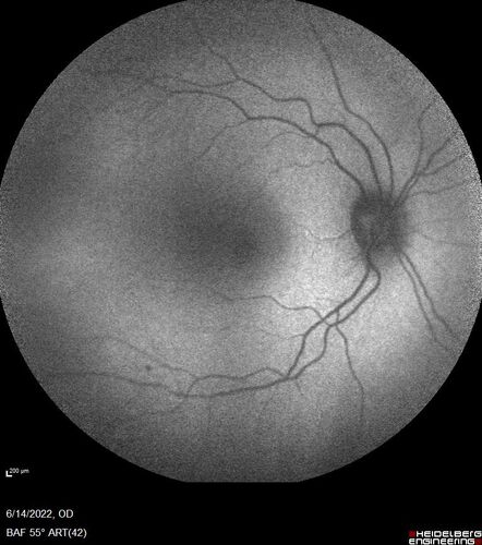Macular pucker in the left eye
Vision was 20/125 pre-op and 20/25 post-op.
