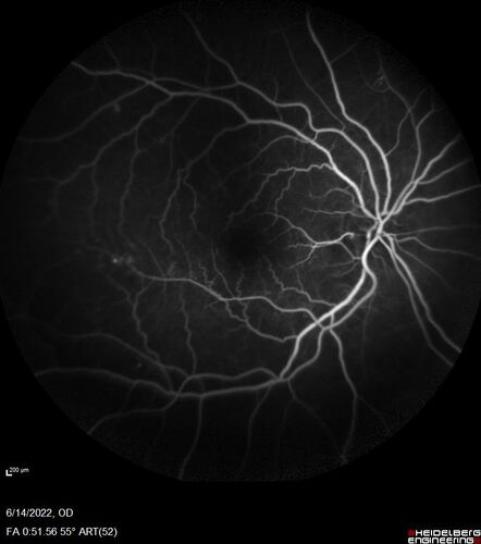 Macular pucker in the left eye
Vision was 20/125 pre-op and 20/25 post-op.

