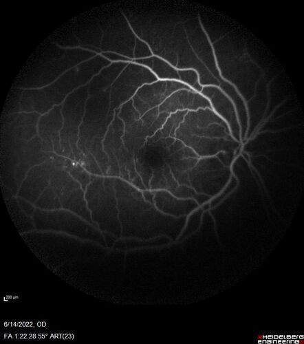 Macular pucker in the left eye
Vision was 20/125 pre-op and 20/25 post-op.
