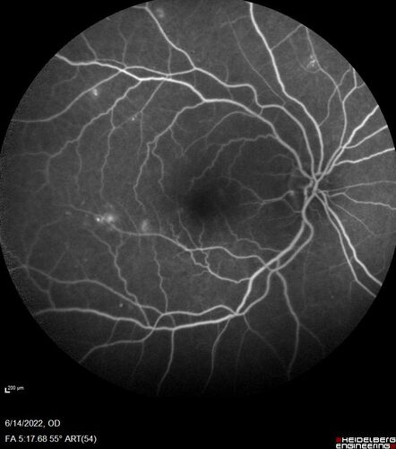 Macular pucker in the left eye
Vision was 20/125 pre-op and 20/25 post-op.
