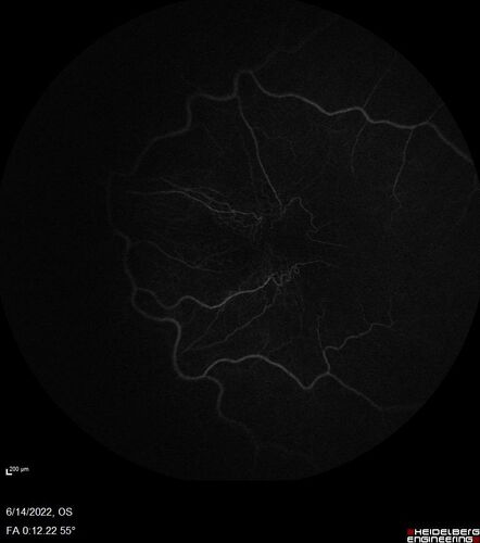 Macular pucker in the left eye
Vision was 20/125 pre-op and 20/25 post-op.
