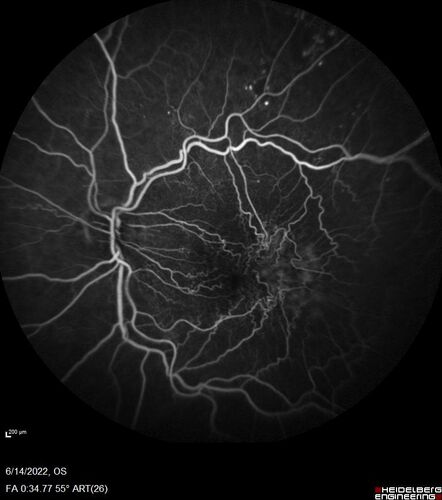 Macular pucker in the left eye
Vision was 20/125 pre-op and 20/25 post-op.
