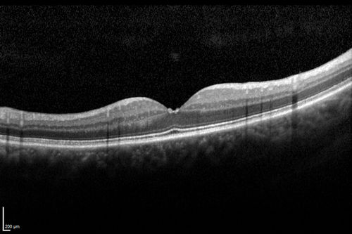 Macular Pucker 20/40 vision - minimal symptoms for 1 year Right eye
SD OCT line Scan Fellow Eye 20/16
