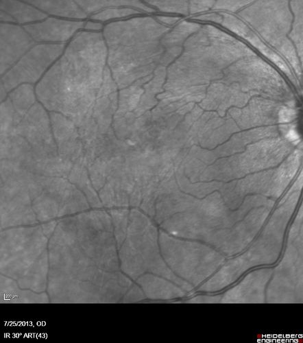 Macular Pucker 20/40 vision - minimal symptoms for 1 year Right eye
IR
