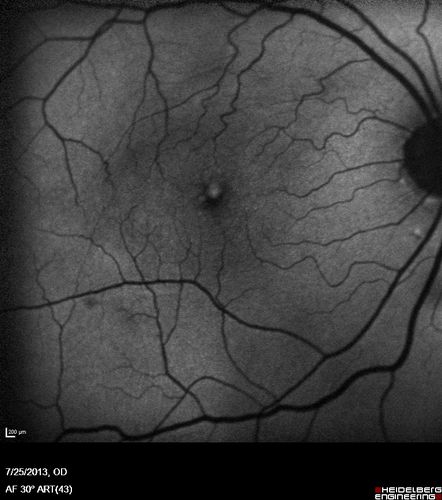 Macular Pucker 20/40 vision - minimal symptoms for 1 year Right eye
Fundus Autofluorescence
