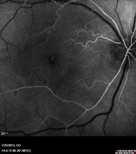 Macular Pucker 20/40 vision - minimal symptoms for 1 year Right eye
FA shows leakage from traction from pucker in the right eye - cystoid macular edema
