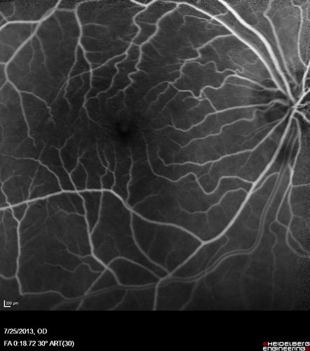 Macular Pucker 20/40 vision - minimal symptoms for 1 year Right eye
FA shows leakage from traction from pucker in the right eye - cystoid macular edema

