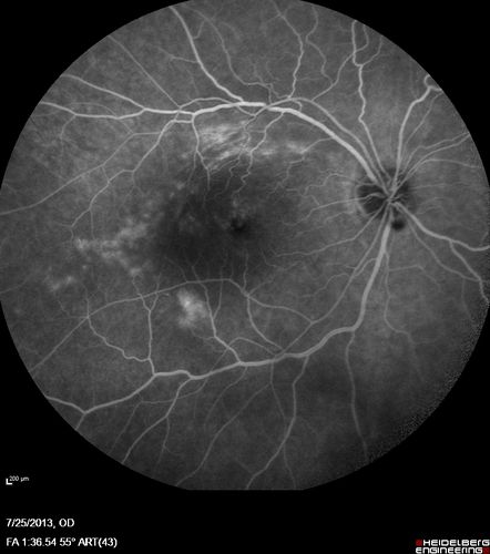 Macular Pucker 20/40 vision - minimal symptoms for 1 year Right eye
FA shows leakage from traction from pucker in the right eye - cystoid macular edema
