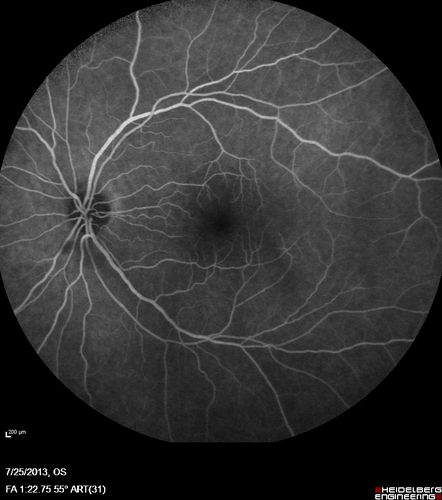 Macular Pucker 20/40 vision - minimal symptoms for 1 year Right eye
FA shows leakage from traction from pucker in the right eye - cystoid macular edema
