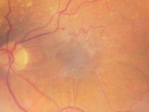 Asymptomatic 20/200 Macular Pucker 79 year old man - Left Eye
79-year-old man who had not noticed a change in vision, but was diagnosed with a macular pucker in the left eye.  Even now he doesnâ€™t notice much difference between the eyes, although he doesnâ€™t usually compare them.  He has a prescription for new glasses.  

VISUAL ACUITY:  OD 20/80,  Pinhole 20/50.  OS 20/200.
