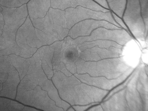Macular Pucker 20/40 Vision 
59-year-old woman blurry vision in the right eye for about the last one or two years.  She had cataract surgery in 1981, a retinal detachment repair with scleral buckle in 1988 in the right eye, and then she had lens implants in both eyes, anterior chamber lenses, in 1994.   She did start taking Latisse for eyelashes about a year and a half ago.

VISUAL ACUITY:  Vision OD is 20/40, OS is 20/20
(4 months later with a short course of antiinflammatory drops and new glasses her vision improved to 20/25)
