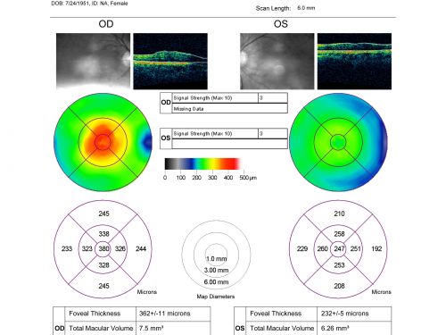 Macular Pucker 20/40 Vision 
59-year-old woman blurry vision in the right eye for about the last one or two years.  She had cataract surgery in 1981, a retinal detachment repair with scleral buckle in 1988 in the right eye, and then she had lens implants in both eyes, anterior chamber lenses, in 1994.   She did start taking Latisse for eyelashes about a year and a half ago.

VISUAL ACUITY:  Vision OD is 20/40, OS is 20/20
(4 months later with a short course of antiinflammatory drops and new glasses her vision improved to 20/25)
