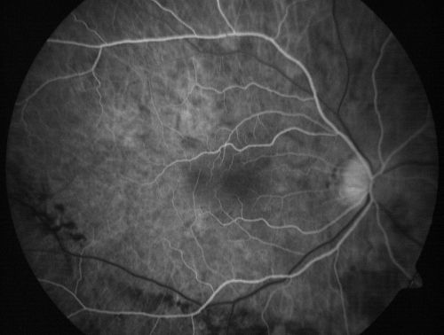 Macular Pucker 20/40 Vision - Pigment Bottom of Photo from Old Retinal Detachment 
59-year-old woman blurry vision in the right eye for about the last one or two years.  She had cataract surgery in 1981, a retinal detachment repair with scleral buckle in 1988 in the right eye, and then she had lens implants in both eyes, anterior chamber lenses, in 1994.   She did start taking Latisse for eyelashes about a year and a half ago.

VISUAL ACUITY:  Vision OD is 20/40, OS is 20/20
(4 months later with a short course of antiinflammatory drops and new glasses her vision improved to 20/25)

