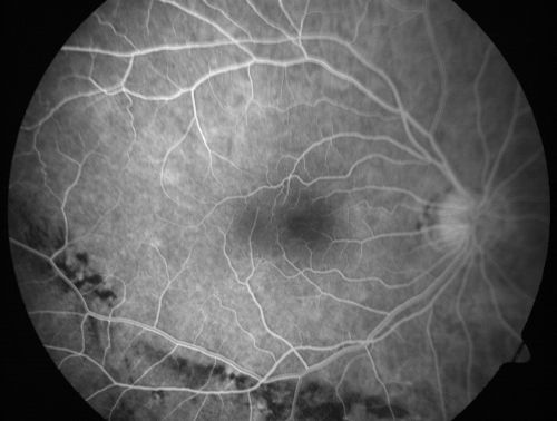 Macular Pucker 20/40 Vision - Pigment Bottom of Photo from Old Retinal Detachment 
59-year-old woman blurry vision in the right eye for about the last one or two years.  She had cataract surgery in 1981, a retinal detachment repair with scleral buckle in 1988 in the right eye, and then she had lens implants in both eyes, anterior chamber lenses, in 1994.   She did start taking Latisse for eyelashes about a year and a half ago.

VISUAL ACUITY:  Vision OD is 20/40, OS is 20/20
(4 months later with a short course of antiinflammatory drops and new glasses her vision improved to 20/25)
