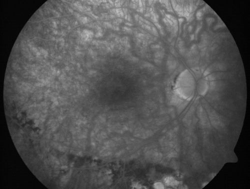 Macular Pucker 20/40 Vision - Pigment Bottom of Photo from Old Retinal Detachment 
59-year-old woman blurry vision in the right eye for about the last one or two years.  She had cataract surgery in 1981, a retinal detachment repair with scleral buckle in 1988 in the right eye, and then she had lens implants in both eyes, anterior chamber lenses, in 1994.   She did start taking Latisse for eyelashes about a year and a half ago.

VISUAL ACUITY:  Vision OD is 20/40, OS is 20/20
(4 months later with a short course of antiinflammatory drops and new glasses her vision improved to 20/25)

