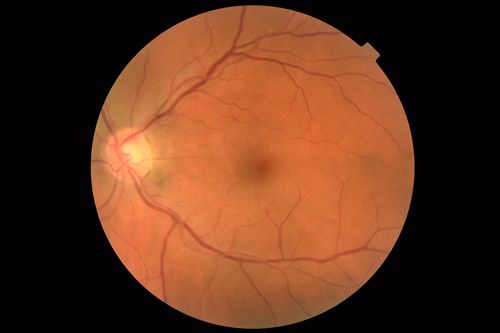 Spontaneously Peeled Macular Pucker 20/20 Vision
