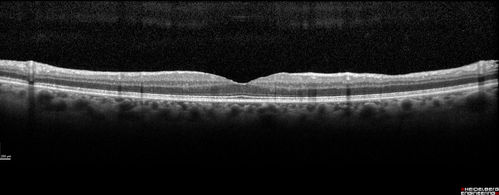 Spontaneously Peeled Macular Pucker 20/20 Vision
