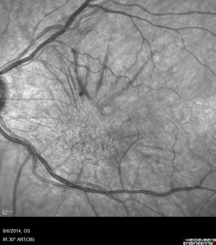 Macular Pucker 20/32 with increased distortion for a month
