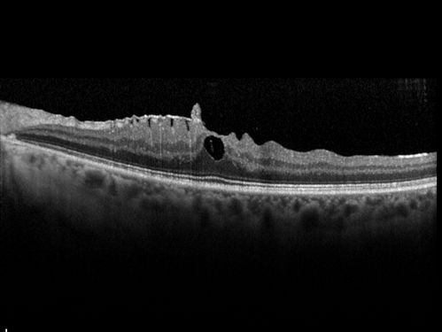 Macular Pucker 20/32 with increased distortion for a month
