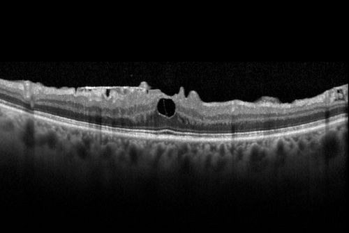 Macular Pucker 20/32 with increased distortion for a month
