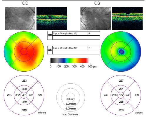 Macular Pucker Pre-op 20/200 vision (history of retinal tears)
66-year-old man has had laser to retinal tears in both eyes in 1999 and in 2001.   His right eye has had rapidly declining vision over the last month.  VISUAL ACUITY:     OD:  20/200
