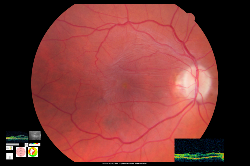 Macular Pucker
Fundus photo with OCT superimposed, 20/100 macular pucker
Keywords: macular pucker