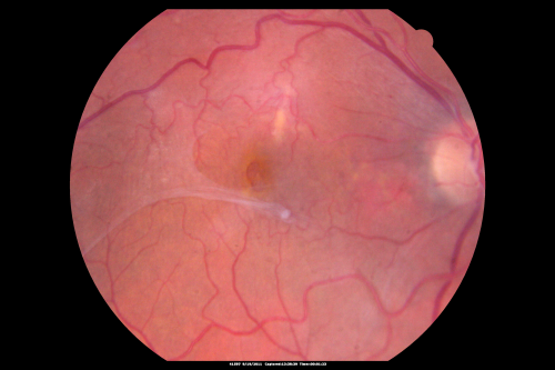 Macular Pucker - Spontaneously Partial Peel after 20 Years.  Vision improved to 20/30
83-year-old woman decreased vision in the right eye for about a month.  20 years ago she was diagnosed with a macular pucker OD 20/50,  OS 20/20.
