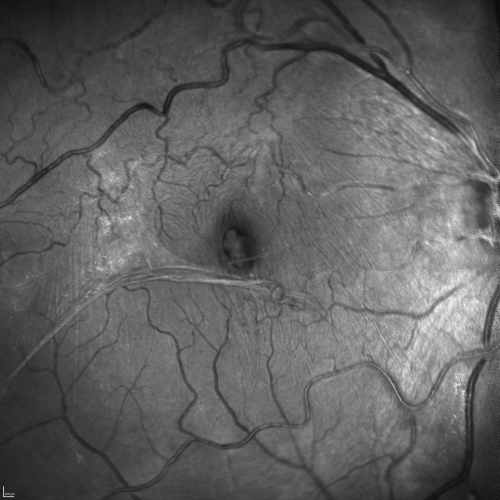 Macular Pucker - Spontaneously Partial Peel after 20 Years.  Vision improved to 20/30
83-year-old woman decreased vision in the right eye for about a month.  20 years ago she was diagnosed with a macular pucker OD 20/50,  OS 20/20.
