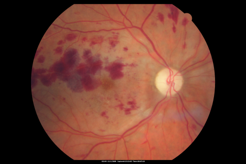 Purtchers Retinopathy with Bilateral Central Retinal Artery Occlusions 
50-year-old man traumatic chest compression and leg crushing injury. OD 1/200, OS 3/200
Keywords: purtcher;purtchers;crao;hemorrhage