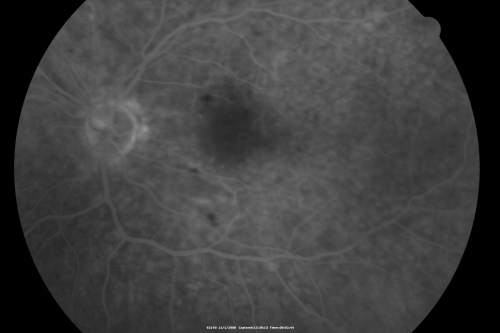 Purtchers Retinopathy with Bilateral Central Retinal Artery Occlusions 
50-year-old man traumatic chest compression and leg crushing injury. OD 1/200, OS 3/200
Schlüsselwörter: purtcher;purtchers;crao;hemorrhage