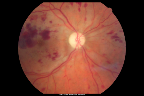 Purtchers Retinopathy with Bilateral Central Retinal Artery Occlusions 
50-year-old man traumatic chest compression and leg crushing injury. OD 1/200, OS 3/200
Keywords: purtcher;purtchers;crao;hemorrhage